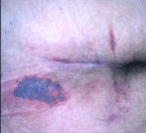 Kennedy Reminal Ulcer