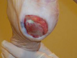 Heel Pressure Ulcer Heel Pressure Ulcer