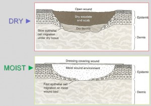 Moist_Dry_Wound_Healing