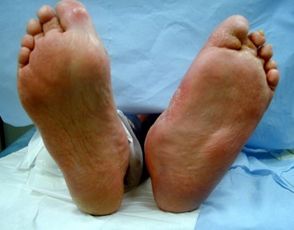 What is Charcot foot? - WCEI - Blog WCEI – Blog