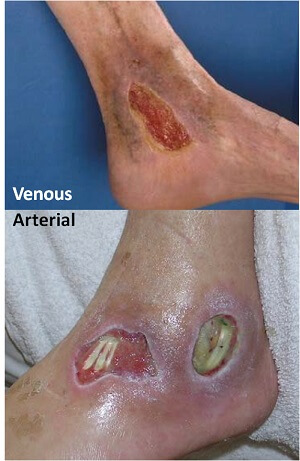 Venous Stasis & Arterial Ulcer Comparison - LHSC