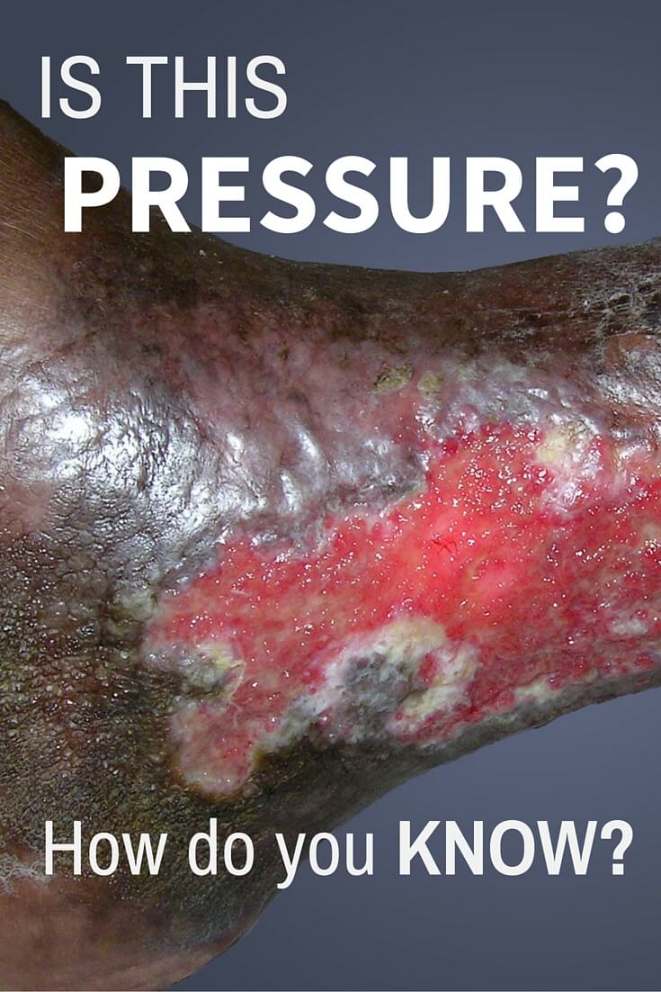 Lower Extremity Ulcers: Go With the Flow - The 2014 International Pressure Ulcer Guidelines mentions performing a vascular assessment on every lower extremity ulcer. That means, at a minimum, we need to check pulses and toe measurements, and perform an ABI. This will assist in identifying the true cause of the wound, whether it be pressure, venous, arterial, or mixed venous/arterial.