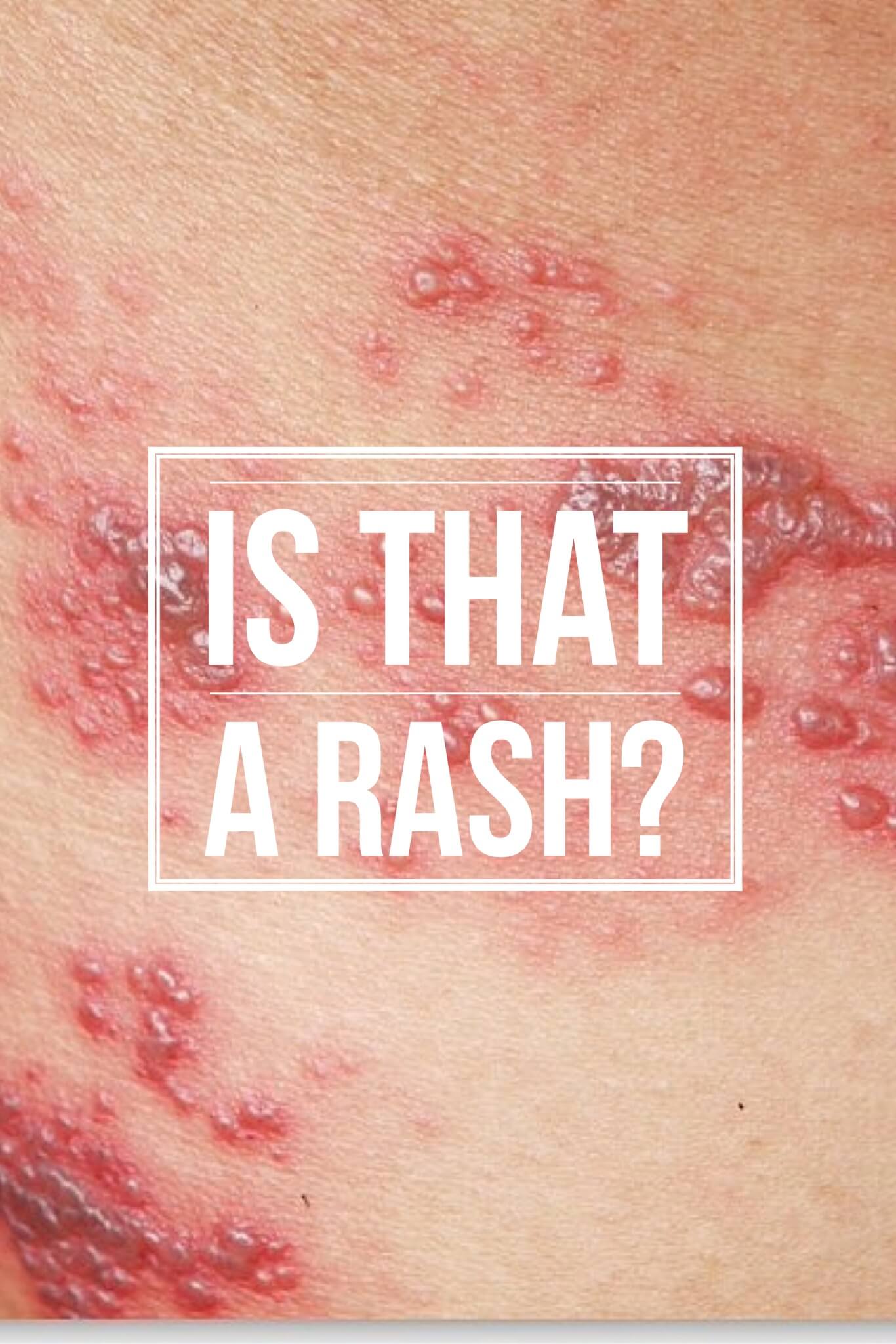 Is That a Rash? Maybe, Maybe Not.
Wound care specialists are often asked to evaluate rashes, and sometimes we just don’t know the answer. So how should you handle such situations? This webinar gives you the answers (watch free with promo code RASH15).