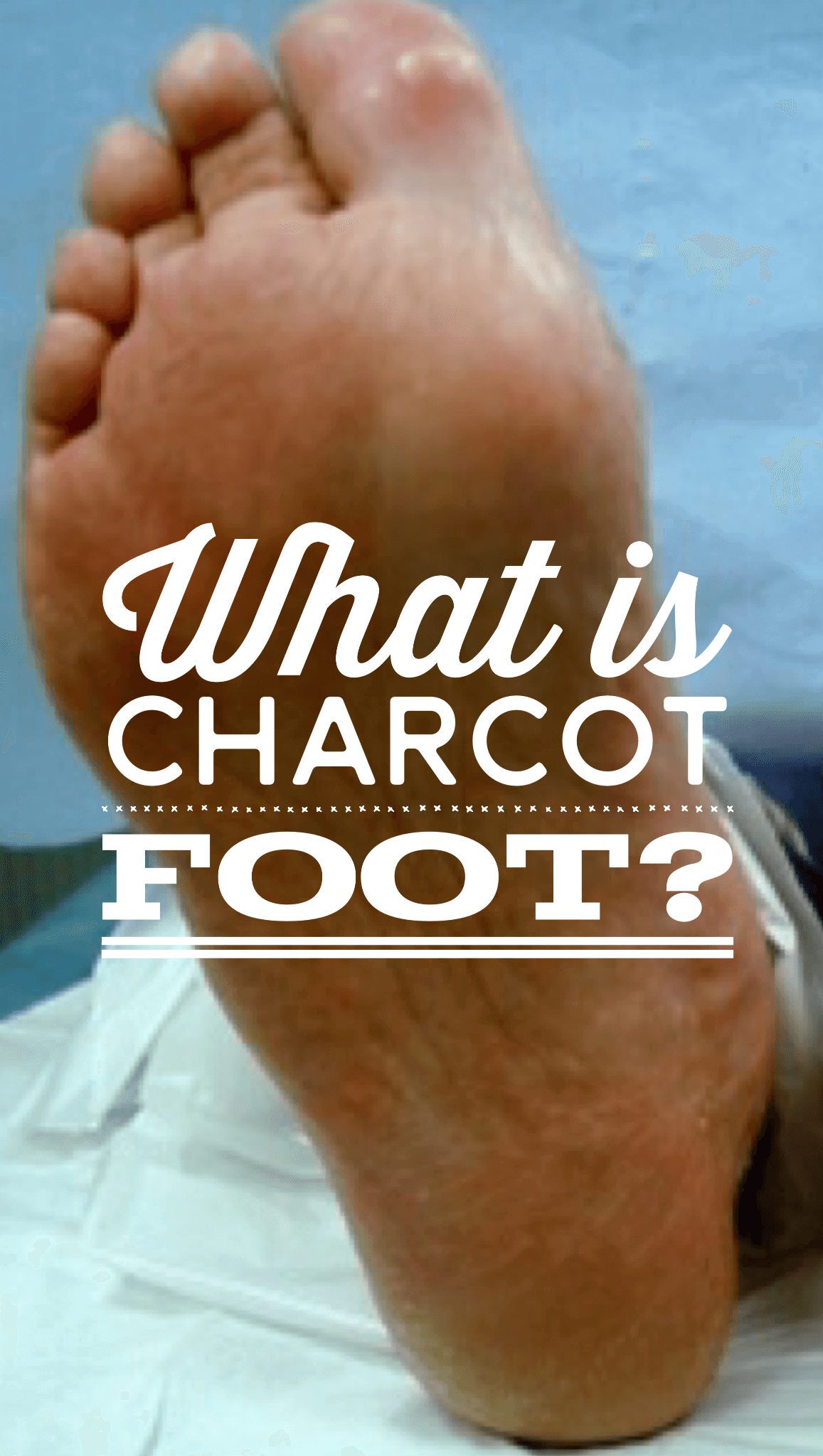 What is Charcot Arthropathy? Charcot foot, as it is commonly referred to, is a chronic progressive disease of the bone and joints found in the feet and ankles of Charcot_Footour diabetic patients with peripheral neuropathy.