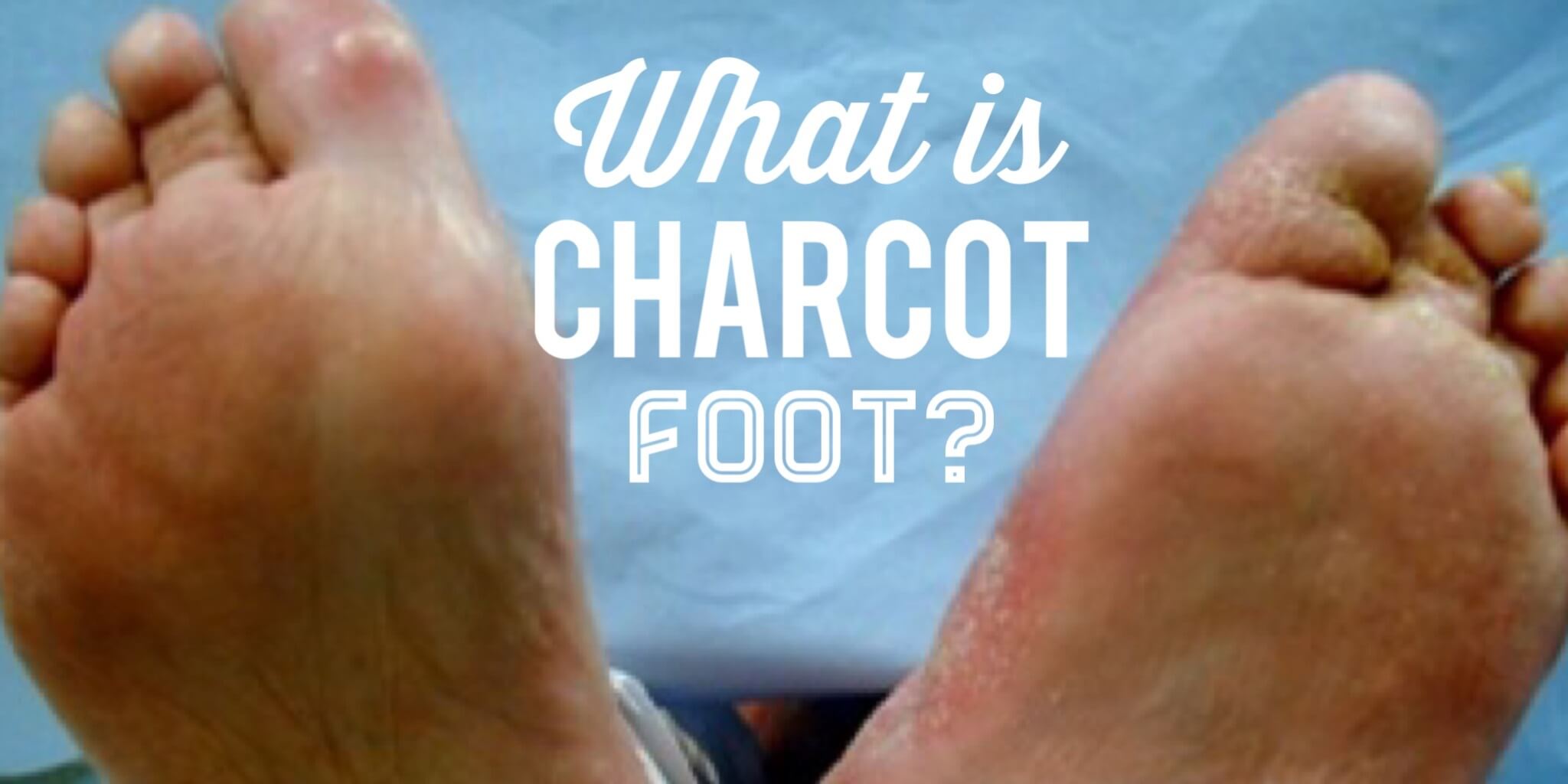 What Is Charcot Foot Wcei Blog Wcei Blog