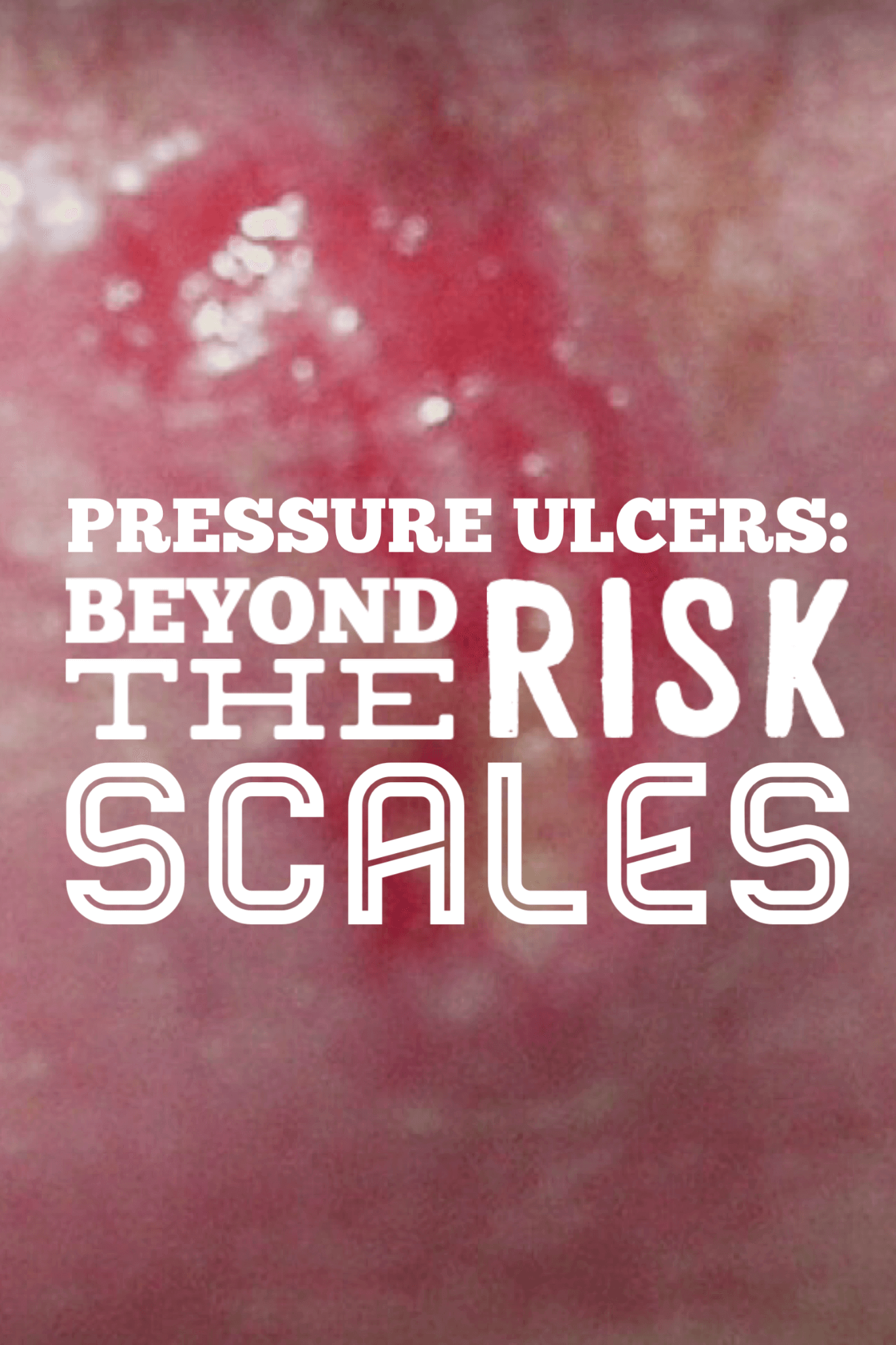 When it comes to pressure ulcer prevention and treatment, traditional risk assessment tools don’t always tell the whole story. Find out what does.