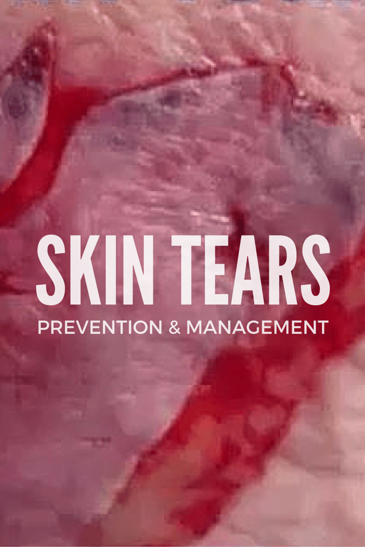 This WCEI free webinar will help wound care professionals understand more about skin tears, including how to treat and prevent them (and help patients heal).