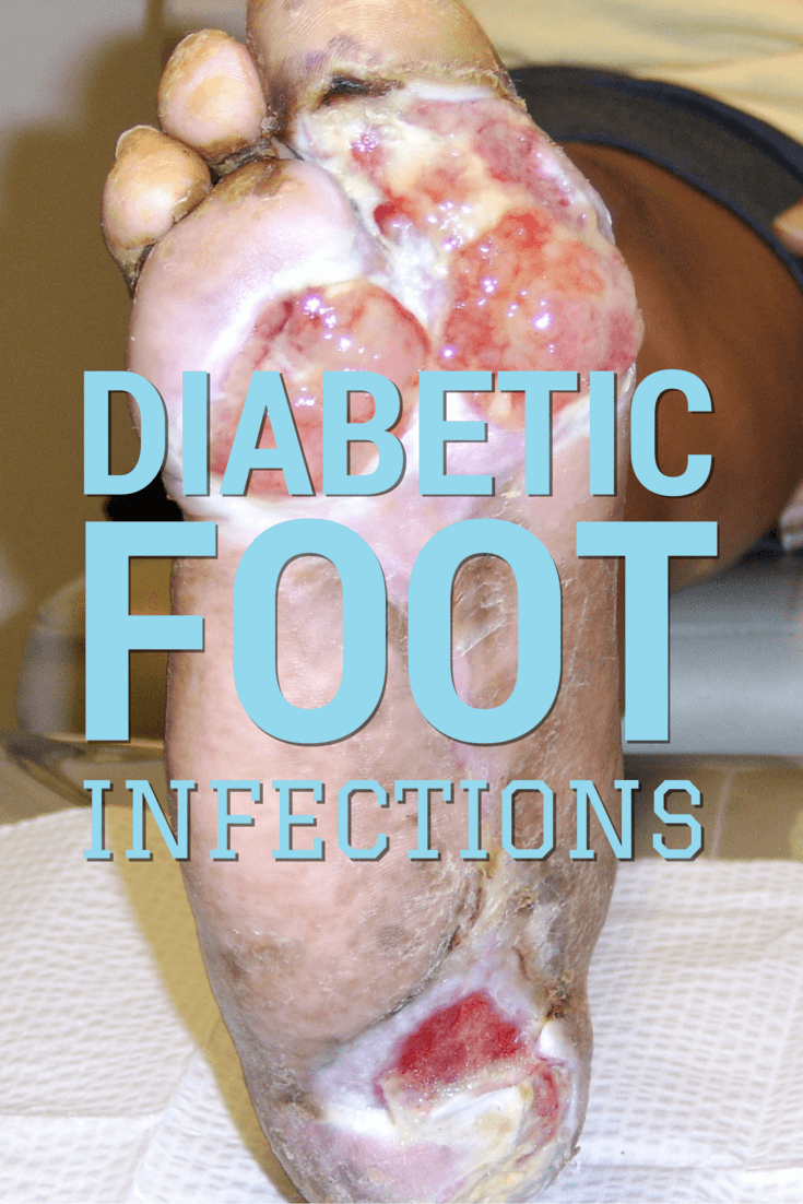 For effective diabetic wound management, clinicians must know the risk factors for foot infections and be able to diagnose them as soon as possible. Get the lowdown here and learn more about diabetic foot ulcers with a FREE webinar.