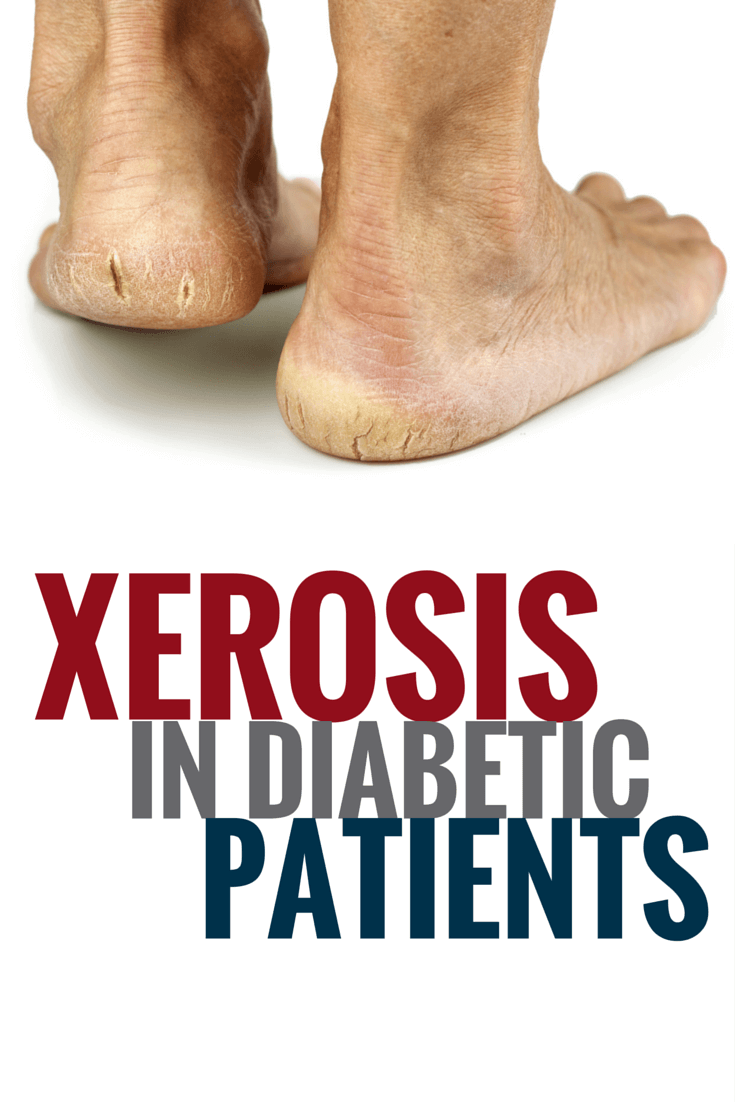 Dry Skin Alert: Foot Xerosis in Diabetic Patients.
Diabetic wound management requires awareness, including knowing the signs and progression of xerosis - an abnormal dryness of skin.