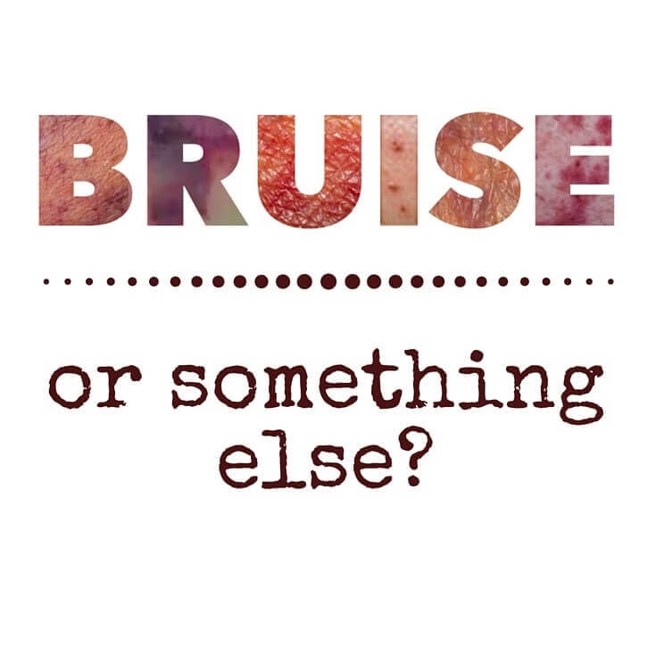 Is it Really a Bruise? Get The Bigger Picture on Skin Lesions - In the world of wound care, clinicians define skin lesions precisely. So what might look like a bruise at first glance could really be a suspected deep tissue injury, purpura . . . or something else. Do you know the difference?