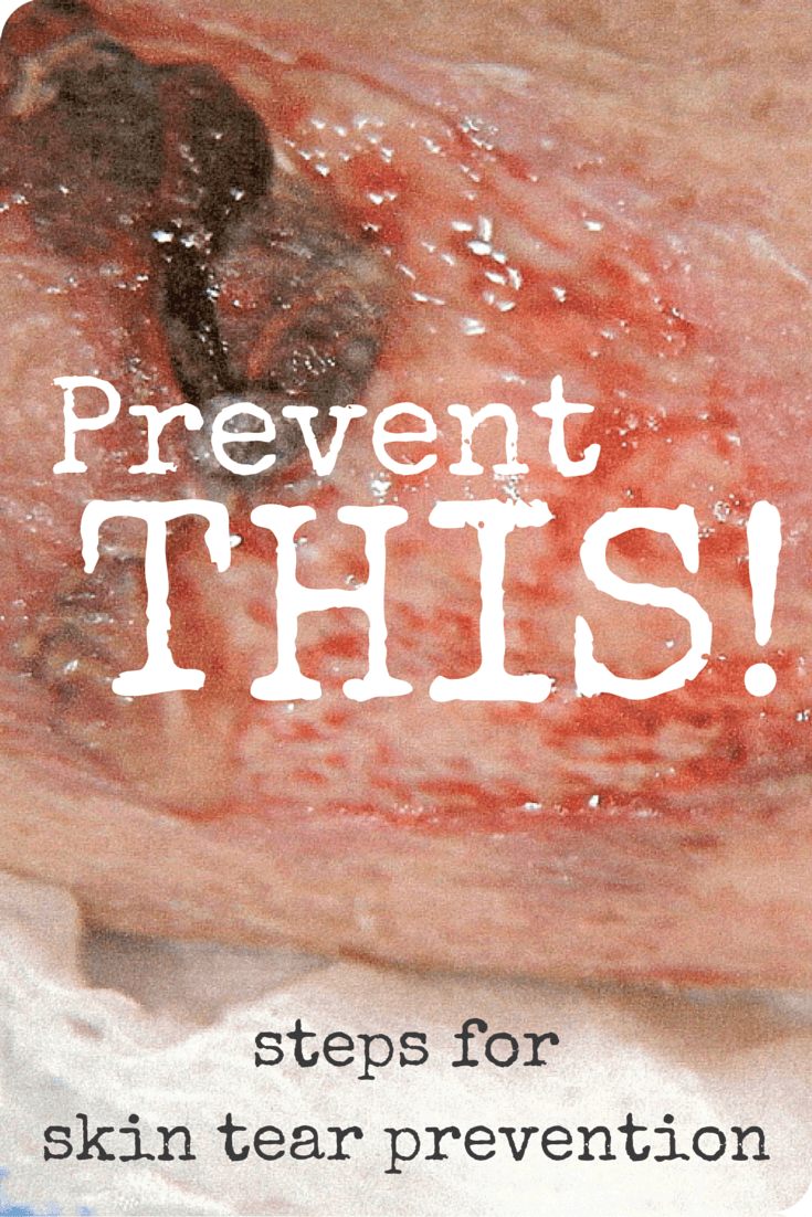 Skin tears are a common condition for the patients we care for, which is why it’s so important for clinicians to know who is at risk, and what can be done to minimize their likelihood.
