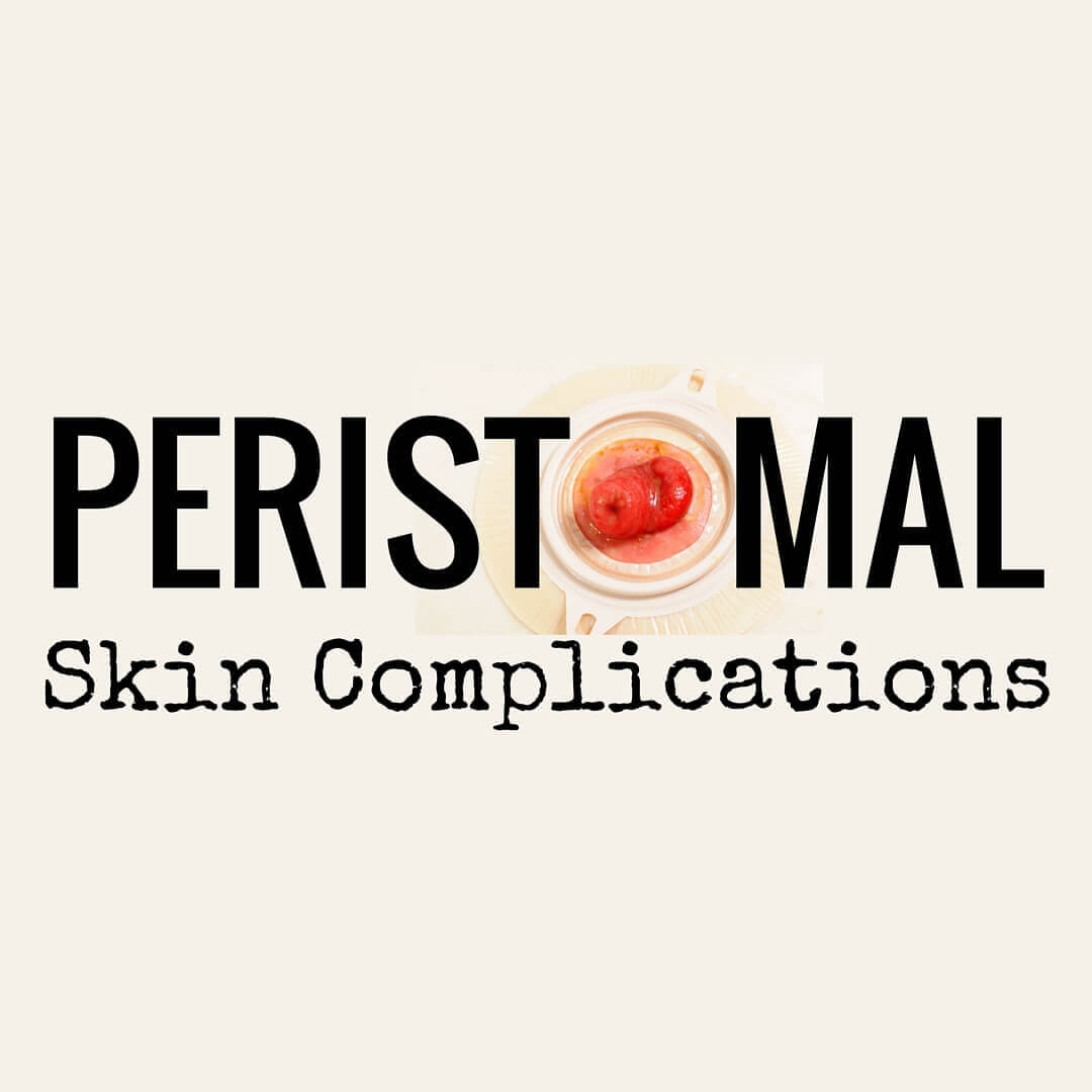 It's Complicated! Ostomy Patients and Peristomal Skin - This overview details the five main categories of peristomal skin complications that wound specialists commonly treat in ostomy patients.