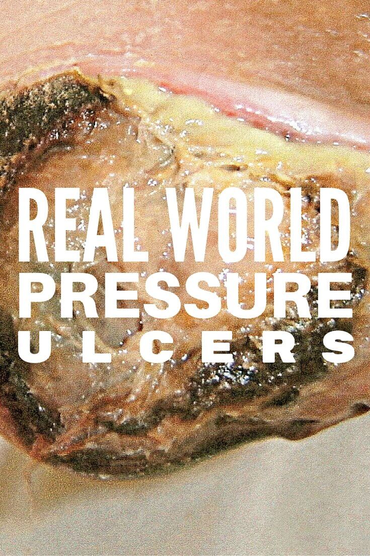 Real World Pressure Injuries: Staging Can Be Tricky - This wound care Q&A answers five of the most common questions about pressure ulcer staging dilemmas (that you probably didn’t learn from textbooks).