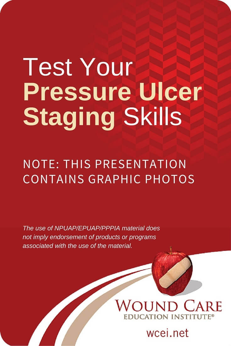 What Stage Is It? Test Your Pressure Ulcer Staging Skills - How well do you know your guidelines for staging pressure ulcers? View the slideshow and test yourself!