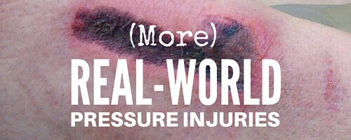 More Real-World Pressure Injuries