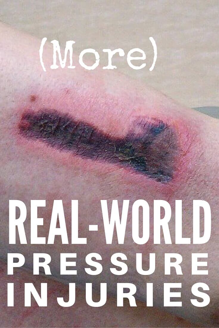 Pressure Injury (Ulcer) Staging: More Real-World Answers - More real-world wound care questions and answers relating to pressure injury staging, including slough, debridement and skin breakdown.