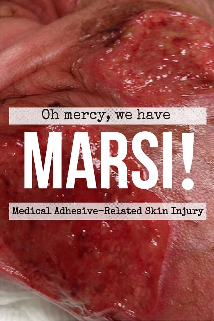 Oh Mercy, We Have MARSI! If you’re in the wound care industry, here’s what you need to know in order to avoid Medical Adhesive Related Skin Injury – also known as MARSI.