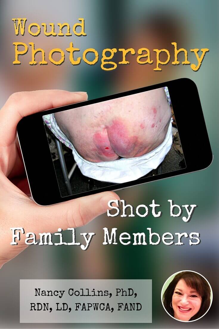 Say Cheese to the Camera: Wound Photography Shot by Family Members - These days, most people have a camera in their pocket, giving family members the ability to take their own wound photographs.