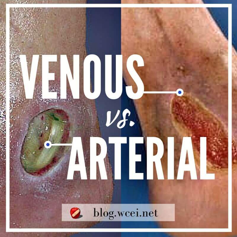 Venous, Arterial or Mixed Ulcer...How Do I Know For Sure? Proper assessment is essential for differentiating between venous and arterial ulcers.