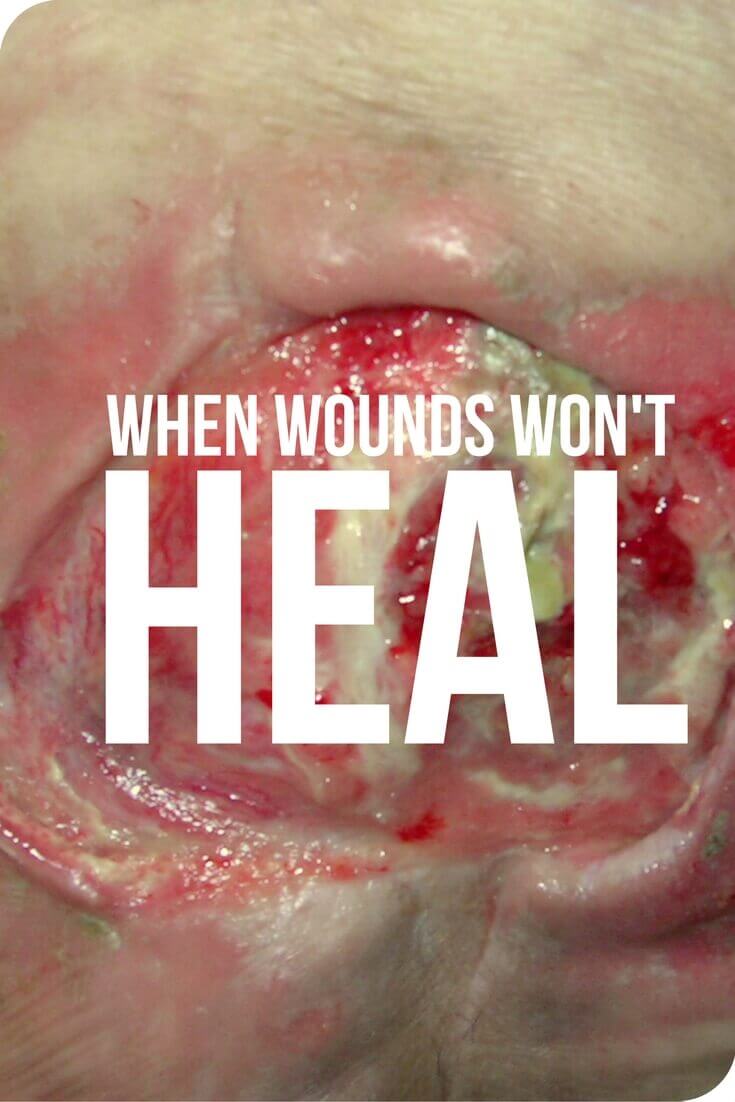 Wound Detective Series: When Wounds Won’t Heal - Ready for some serious detective work? In this case, our focus is on those chronic wounds that just won’t heal.