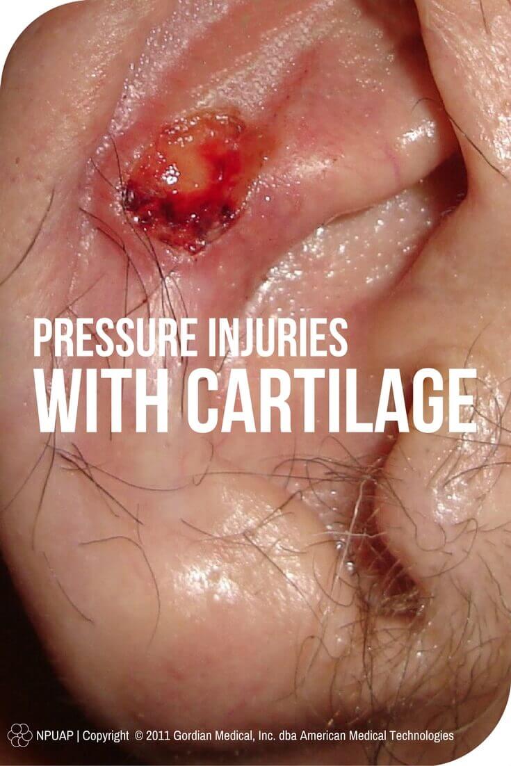 Pressure Injuries with Cartilage? Stage Away! When it comes to wound care, staging pressure injuries with visible or palpable cartilage doesn’t have to be complicated. Here’s what to do.
(Photo: NPUAP copyright & used with permission)