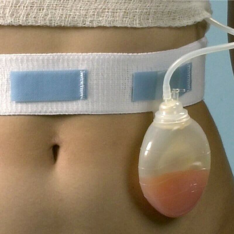 Put those safety pins away! A home care nurse's invention, the Drain Bulb Holder, is making a difference in post-surgery care.