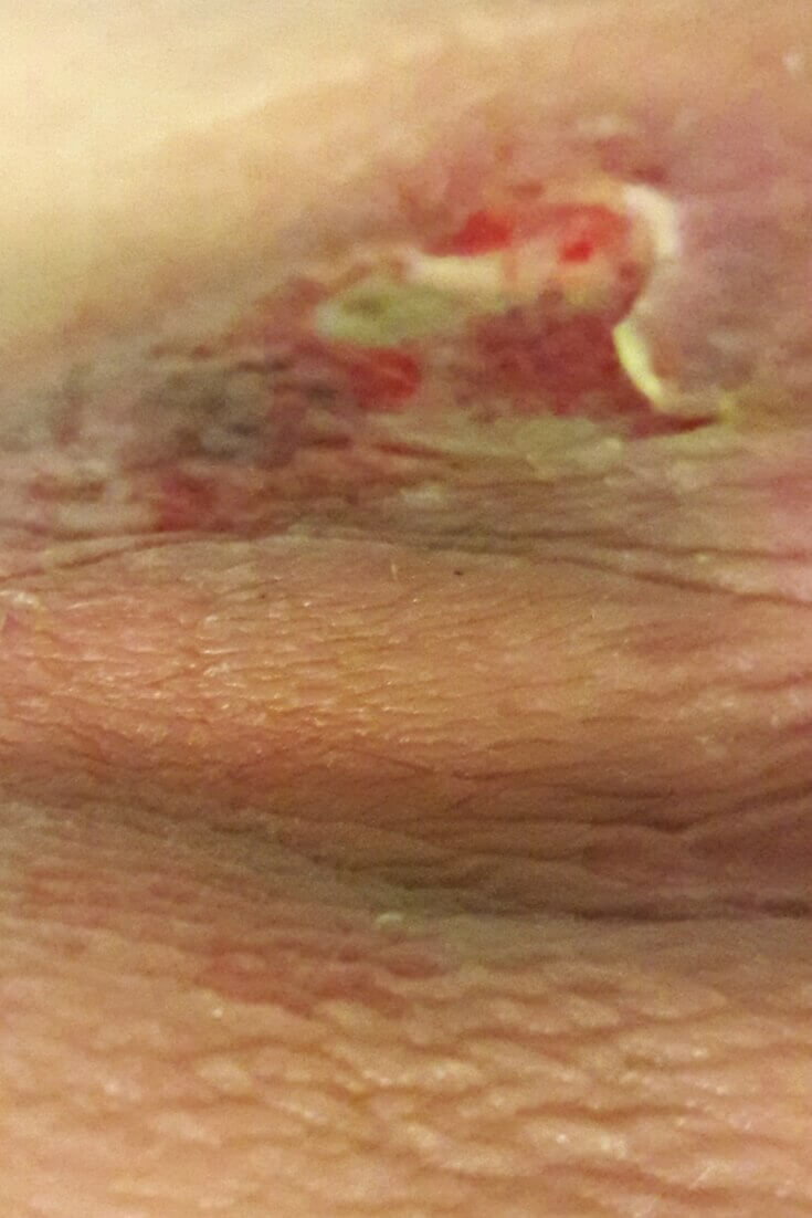 Pressure Injury Case Shines Spotlight on Wound Care Education - Trained wound care clinicians truly make a difference in the lives of their patients. This caregiver knows first-hand, and wanted to share her story.