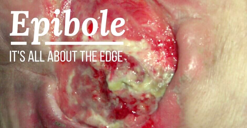 Wound Care and Epibole: It's All About the Edge - WCEI - Blog WCEI – Blog