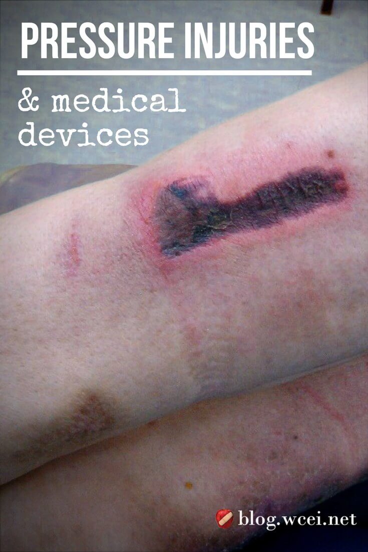 Pressure Injuries and Medical Device Dilemmas - Medical device-related pressure injuries (MDRPIs) are a standard part of wound care, but preventative practices can make a big difference.