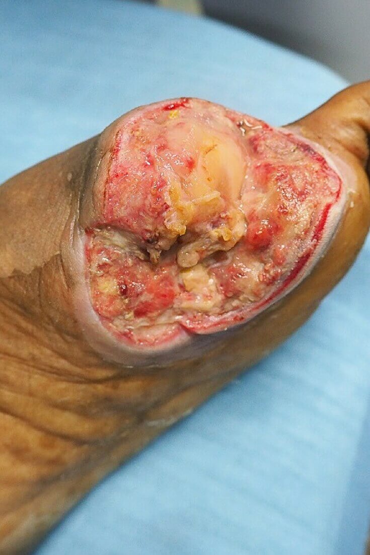 The Next Generation of Negative Pressure Wound Therapy – V.A.C. VERAFLO™ Therapy