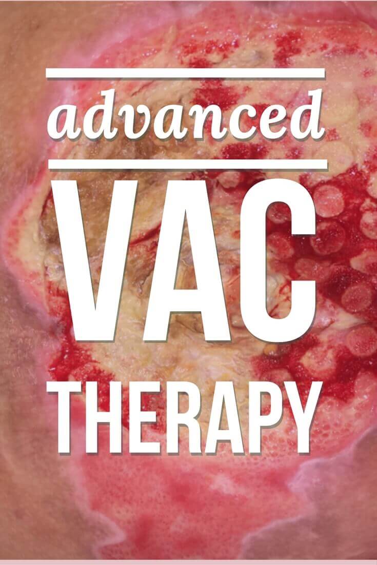 Advanced VAC Therapy: When is the Right Time to Step Up Your Game? - A clinical nurse specialist describes when Negative Pressure Wound Therapy with Instillation has made a difference in her clinical practice.
