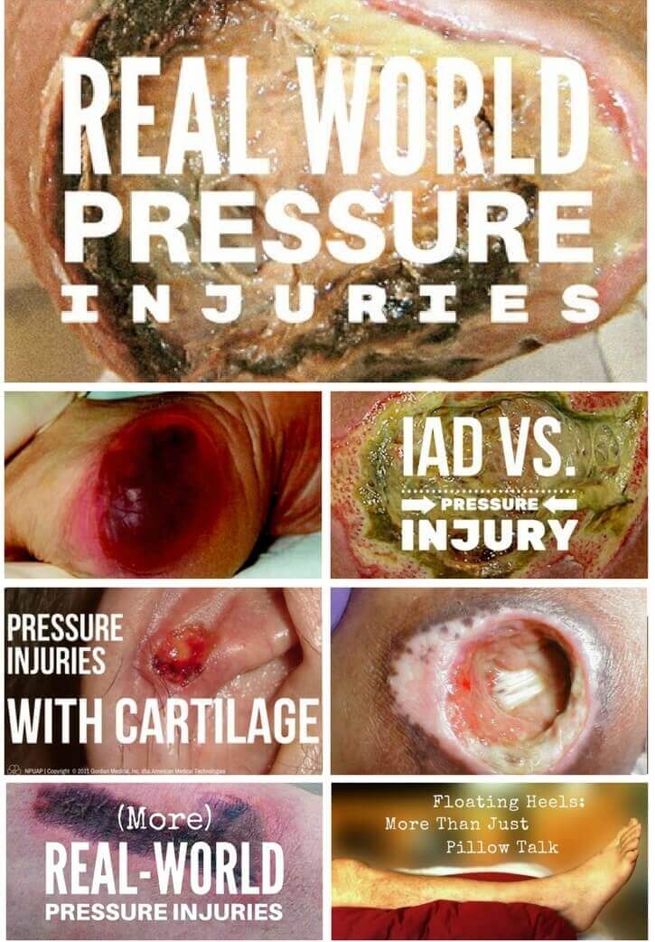 Here are 20 free WCEI resources on pressure injuries (webinars, blogs, guides and more) to keep you current.