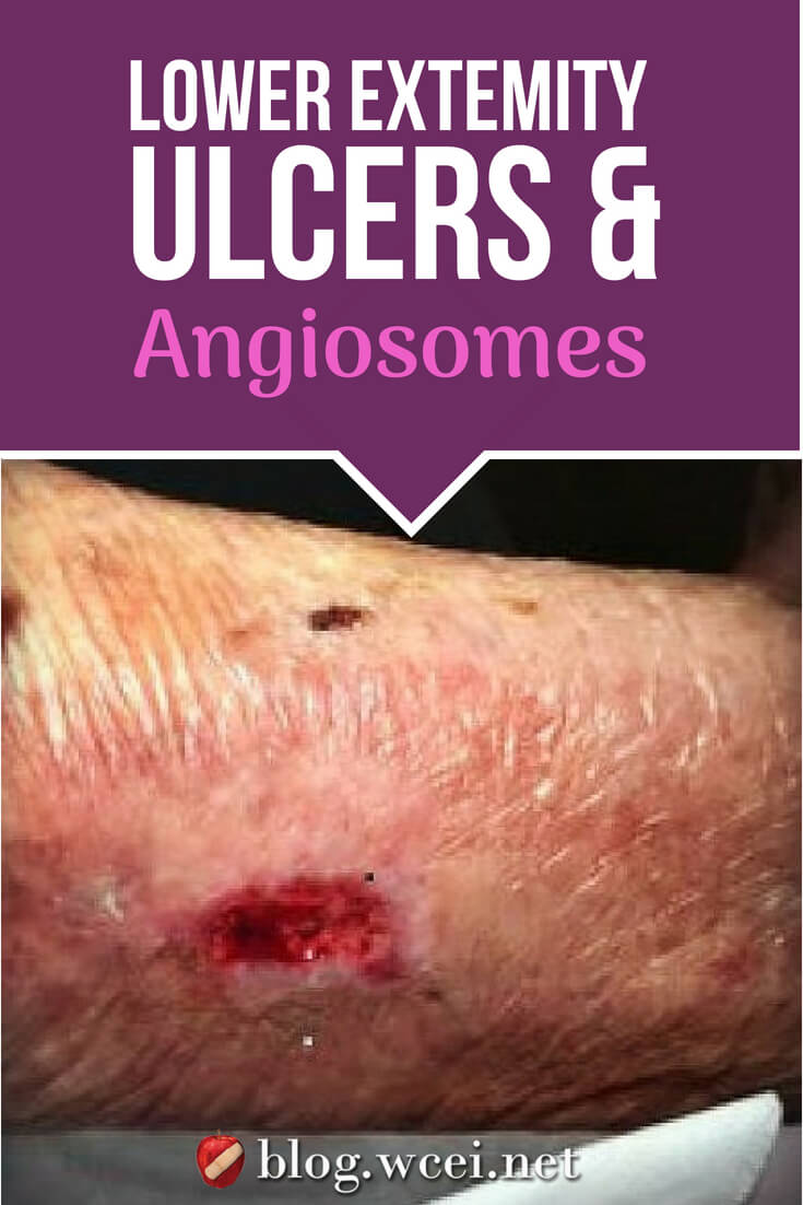 What is an angiosome and how does it relate to wound healing? Learn how angiosomes can help identify patients who need vascular intervention.