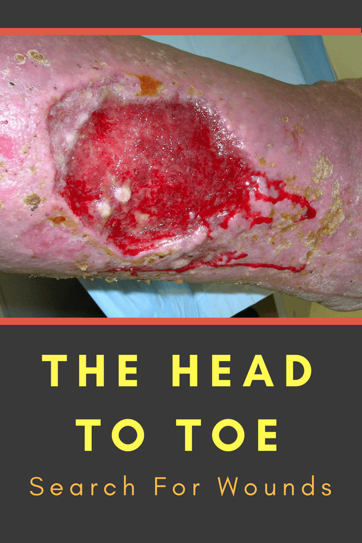A comprehensive skin assessment should look for more than just wounds because many medical problems have telltale signs that are easy to see if you know what to look for. Dr. Nancy Collins takes us through