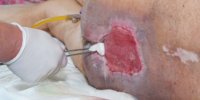 pressure injuries