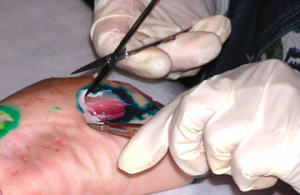 Sharp Debridement