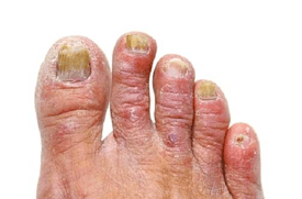 diabetic toenails