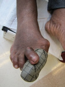 Polymem Silver Toe dressing to combat bioburden