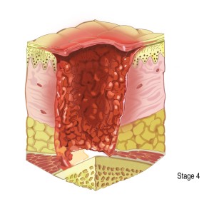 stage a wound when cartilage is present