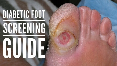 Diabetic Foot Screening Guide