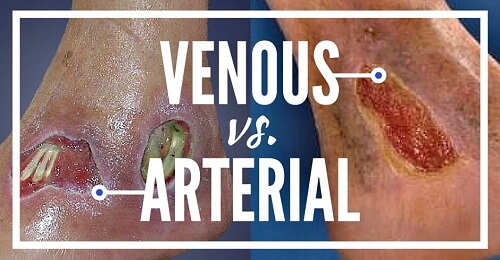 Venous, Arterial or Mixed Ulcer...How Do I Know For Sure?