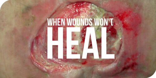 Wound Detective Series: When Wounds Won't Heal | WCEI