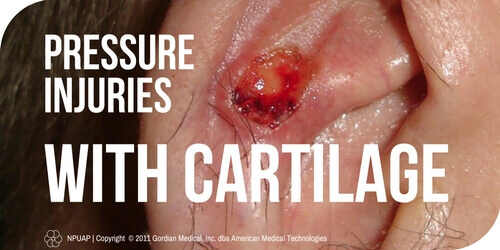 Cartilage Pressure Injuries