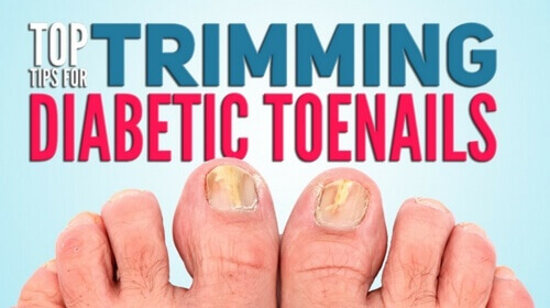 Black Toenails: Causes, Prevention Tips, and How to Treat