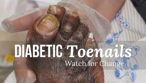 Diabetic Toenails: Watch for Change | WCEI