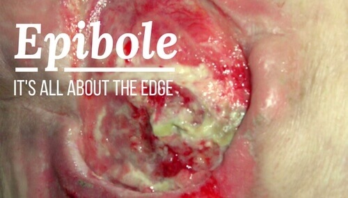 Wound Care and Epibole It s All About the Edge WCEI