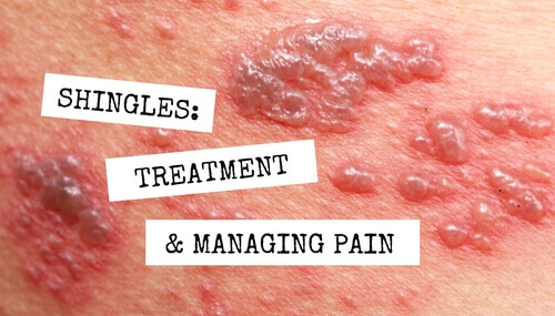 Shingles: Treatment and Managing Pain