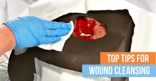Top Tips for Best Wound Cleansing Practices