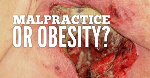 Malpractice or Obesity?