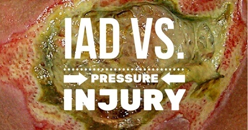 IAD vs Pressure Injuries